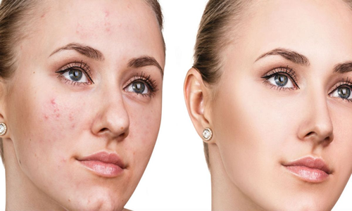 Cómo eliminar manchas de acné