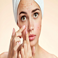 Remedios caseros contra el acné