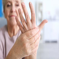 Artritis reumatoide Síntomas y causas