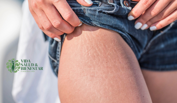 La celulitis prevencion y tratamiento