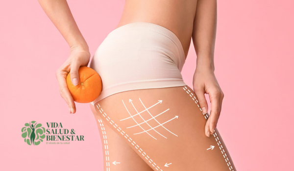 La celulitis prevencion y tratamiento