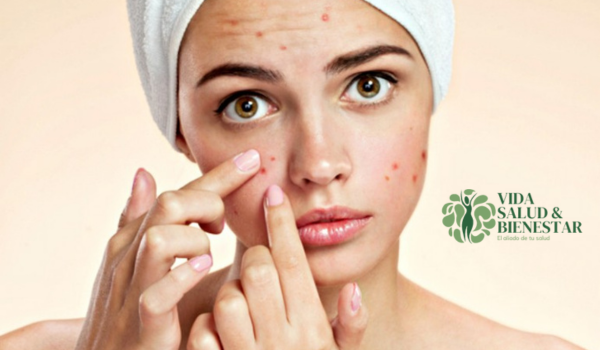 Como eliminar el acne naturalmente